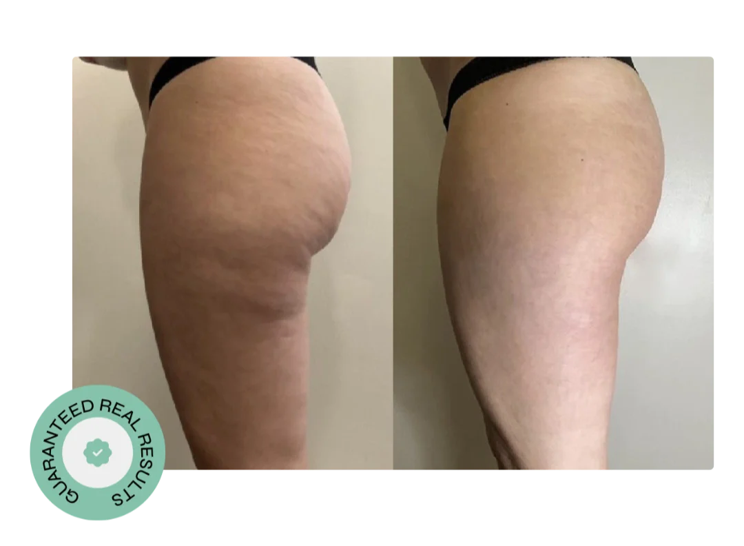 Cellulite treatment results